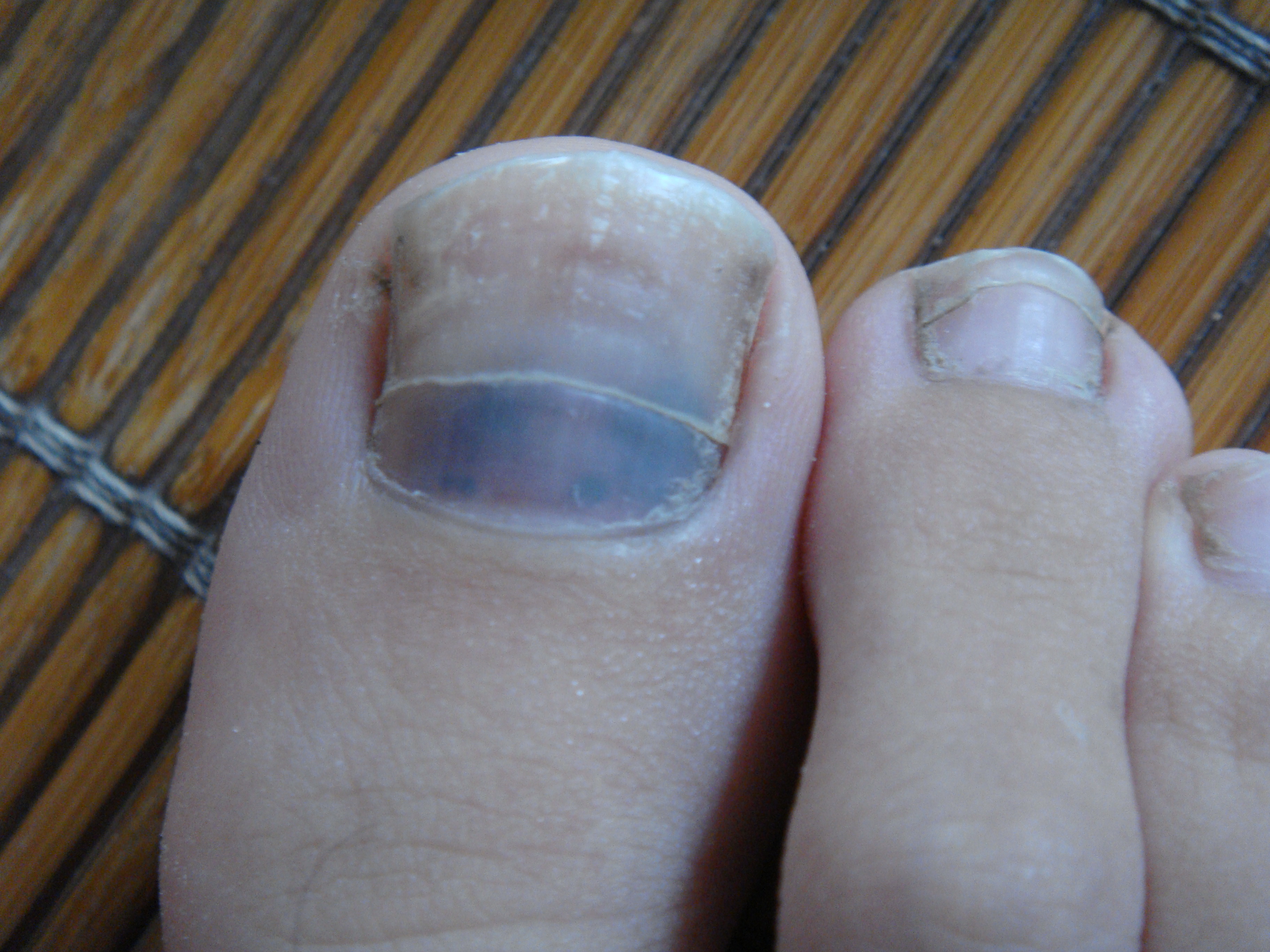 女 脚大拇指趾甲为什么有黑色的 不痛不痒 看起来好像里面有淤血 这是为什么呢？_百度知道