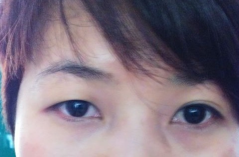 手术后,一大一小的眼睛让我想死!_医网病友论