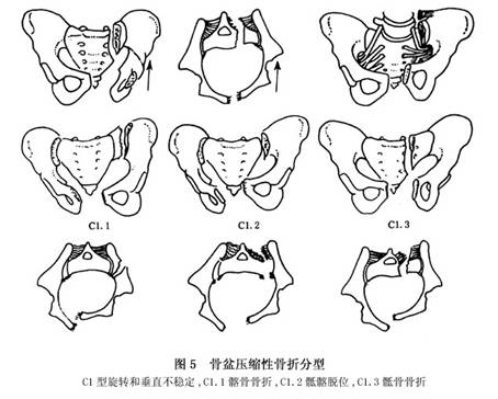 诊疗常识_骨盆骨折_骨科_疾病库_医网