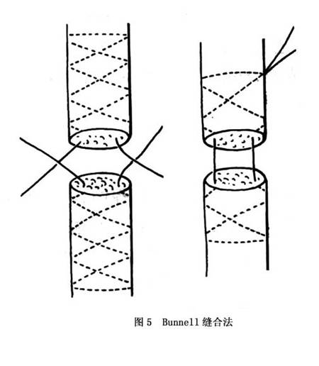 诊疗常识_手部屈指肌腱损伤_手外科_疾病库_