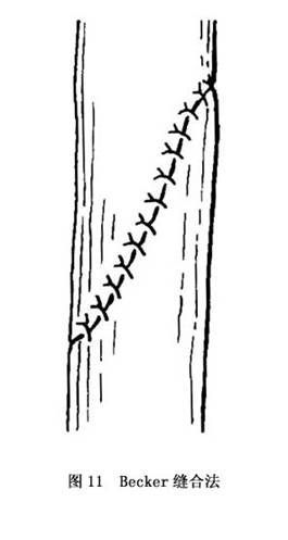 诊疗常识_手部屈指肌腱损伤_手外科_疾病库_