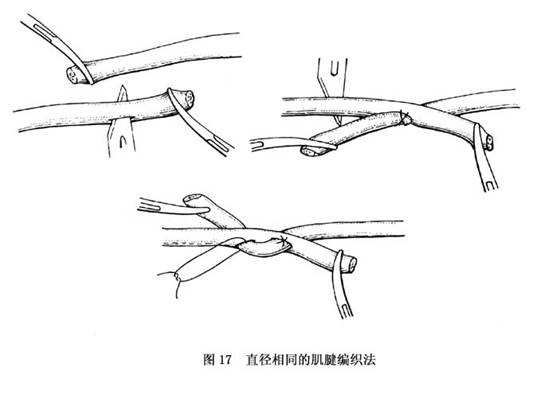 诊疗常识_手部屈指肌腱损伤_手外科_疾病库_