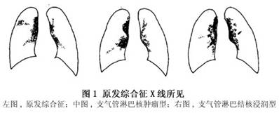 诊疗常识_<em>小儿原发型肺结核</em>_儿科疾病_疾病库